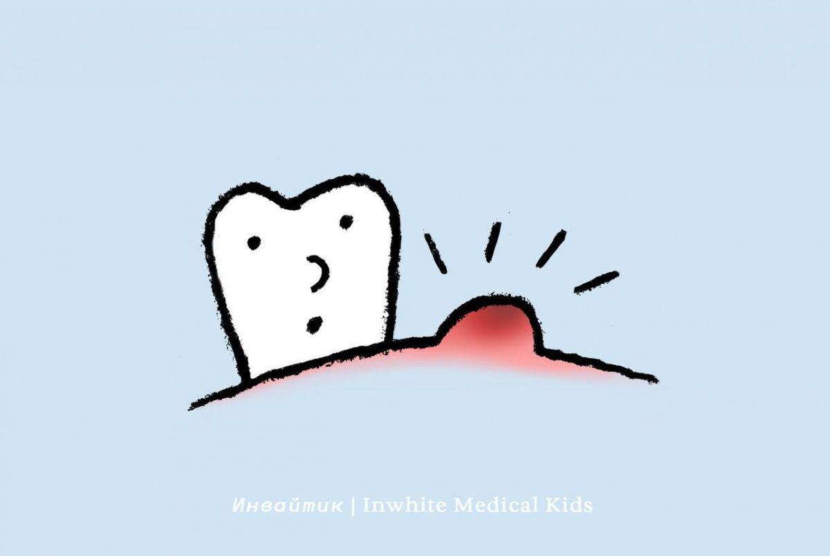 У ребёнка появилась язвочка в полости рта. Это стоматит?