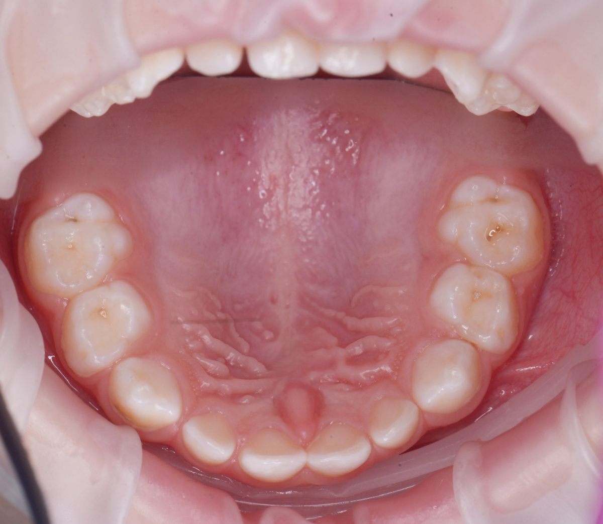  - before the procedure