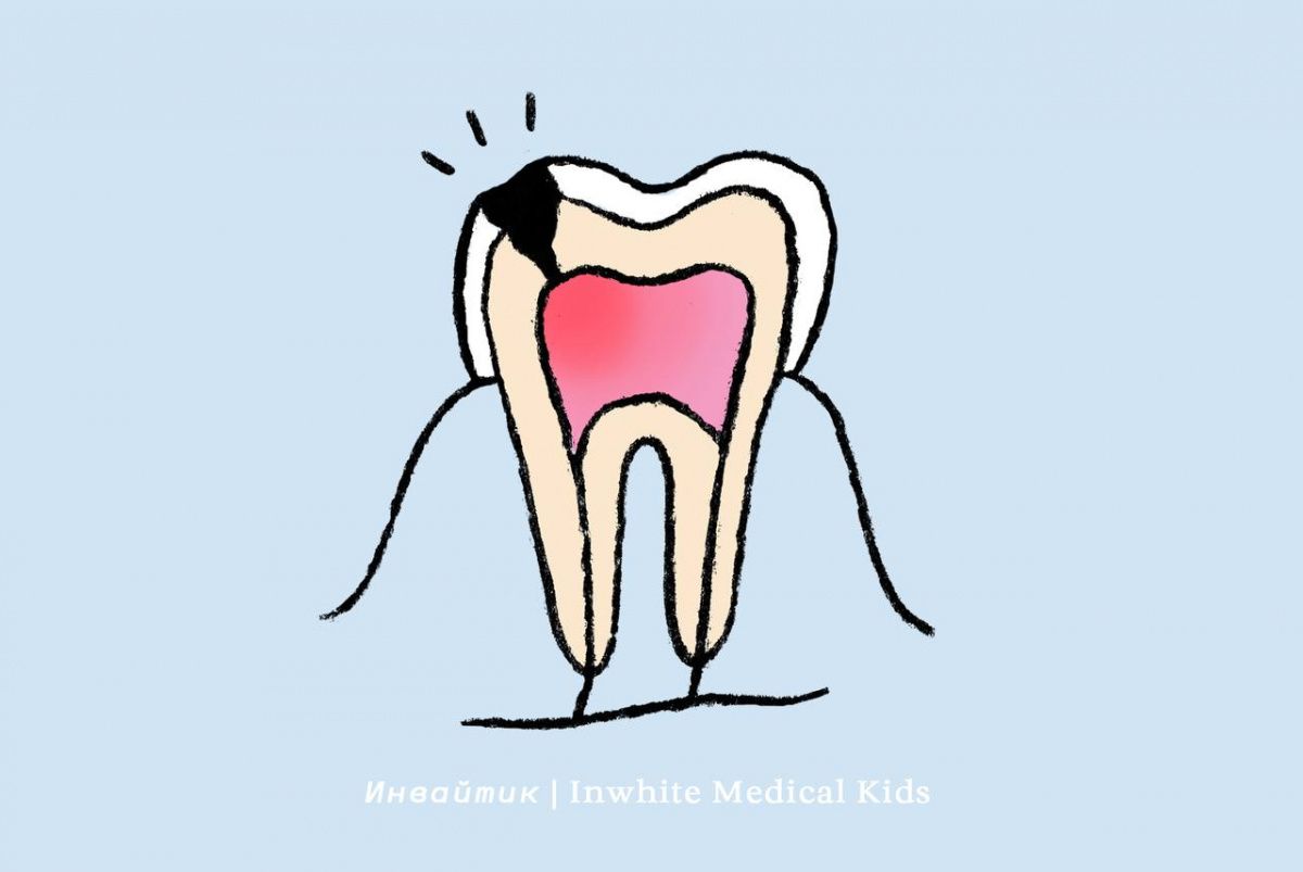 Как мы лечим пульпит у детей?