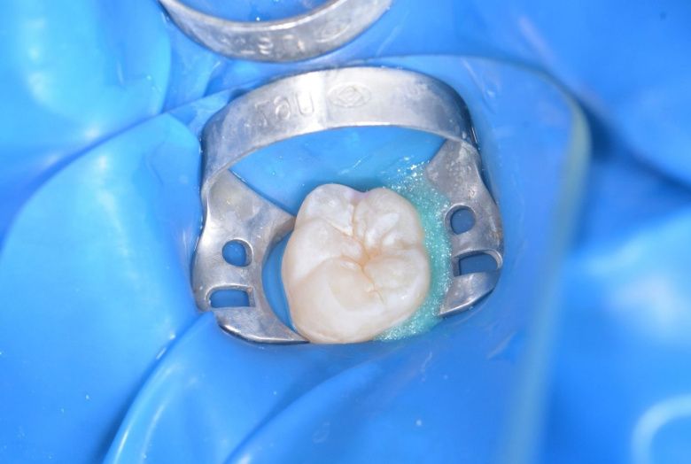  - photo before the procedure
