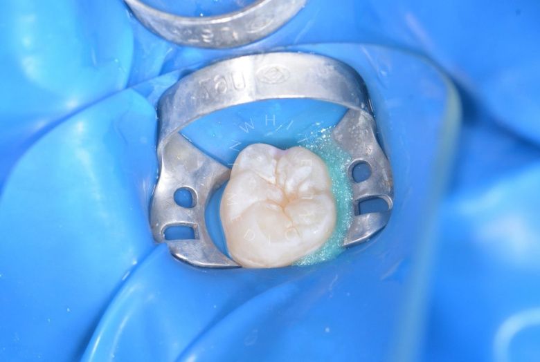  - photo before the procedure