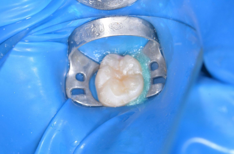 Детская стоматология во сне. Герметизация фиссур постоянного зуба - photo after the procedure
