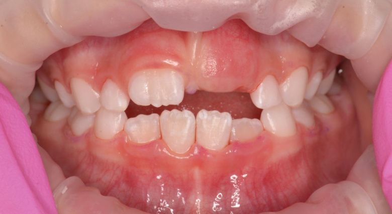  - photo after the procedure
