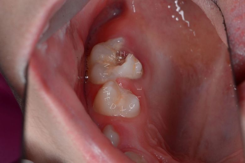  - photo before the procedure