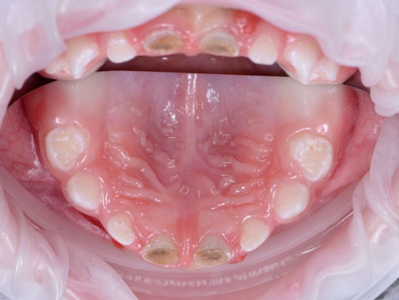 Самые лучшие детские стоматологи. Лечение зубов под наркозам у детей - фото до процедуры