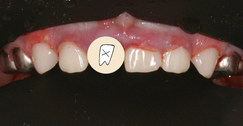  - photo after the procedure