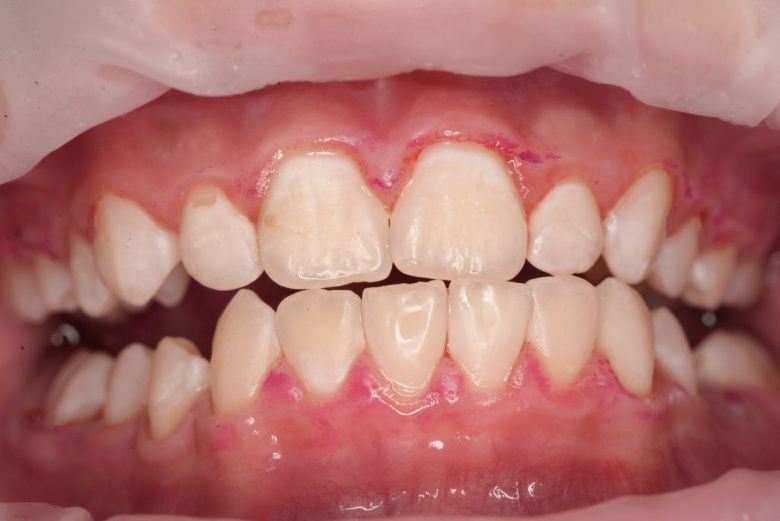  - photo after the procedure