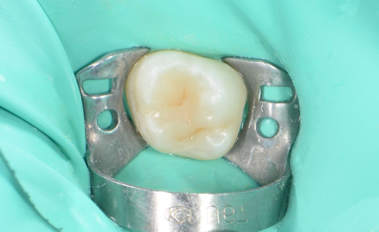  - photo after the procedure