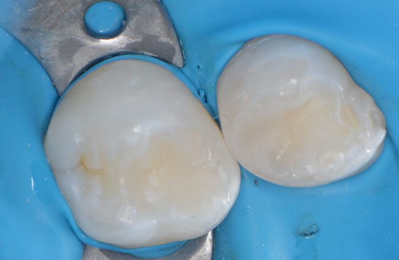  - photo after the procedure