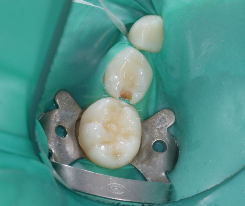 Самые лучшие детские стоматологи. Лечение контактного кариеса у детей - фото до процедуры