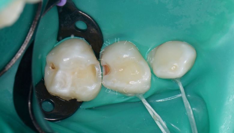 Самые лучшие детские стоматологи. Лечение контактного кариеса зубов - фото до процедуры