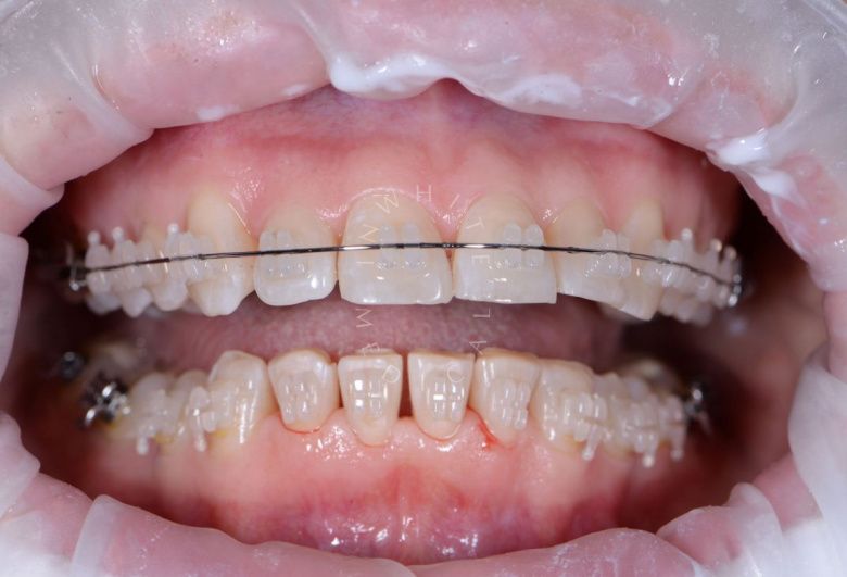  - photo after the procedure