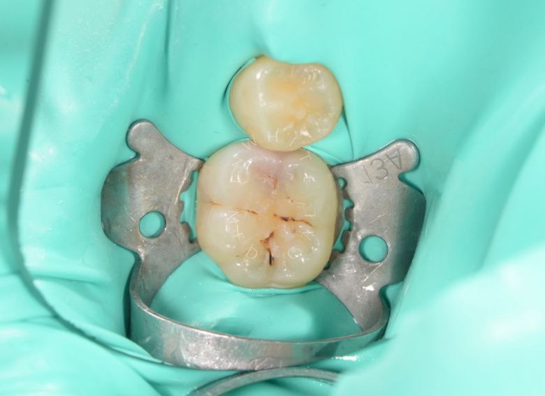 Детская стоматология Раменки. Лечение кариеса жевательного зуба детям - фото до процедуры