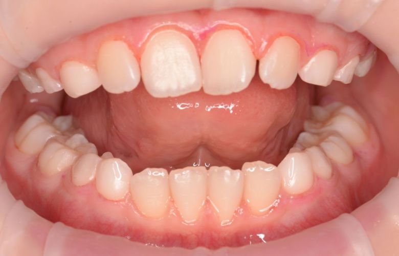  - photo after the procedure