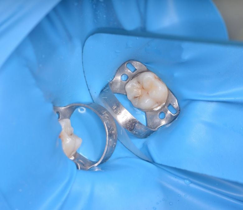 Лучшие стоматологии детские платные. Лечение кариеса у детей с восстановлением фиссур - фото до процедуры