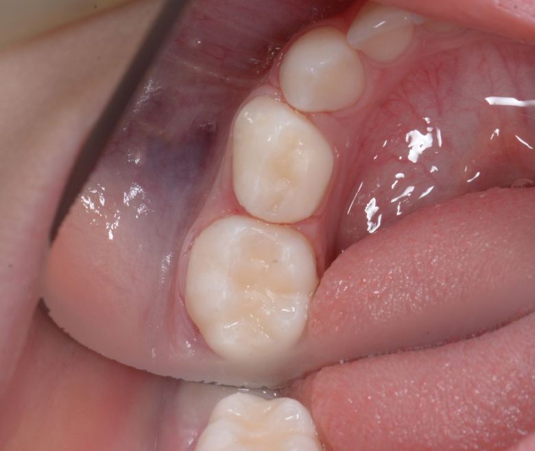  - photo after the procedure