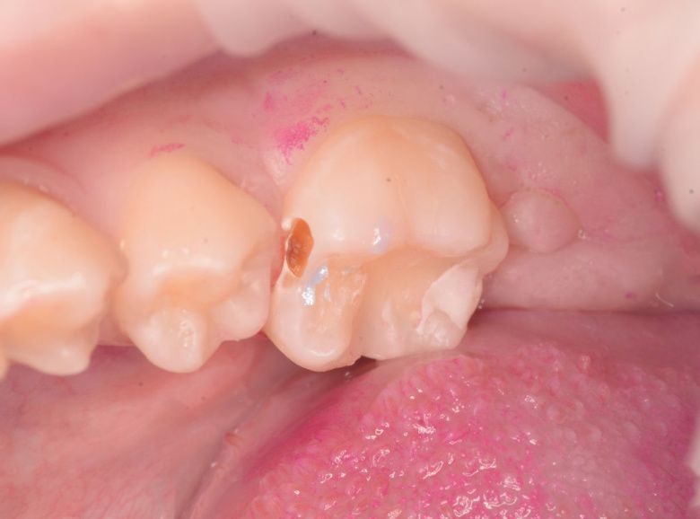  - photo before the procedure