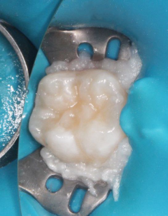  - photo after the procedure