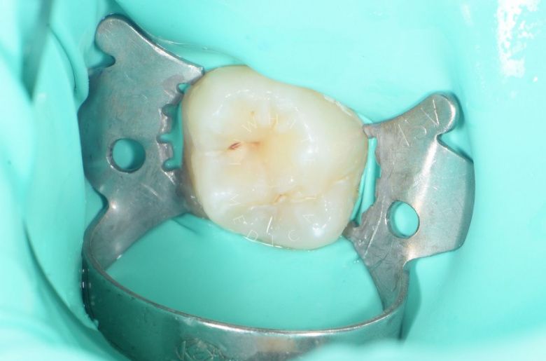 Детская стоматология Раменки. Лечение кариеса жевательного зуба у подростка - фото до процедуры