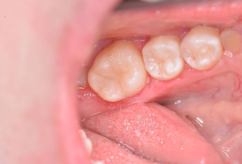 Лучшие стоматологии детские платные. Лечение скрытого кариеса постоянного зуба - фото после процедуры