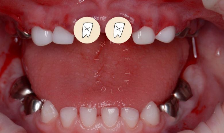 Лучшие стоматологии детские платные. Лечение во сне - установка керамических и металлических коронок - фото после процедуры
