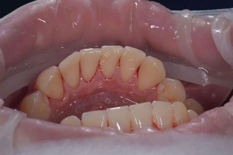  - photo after the procedure
