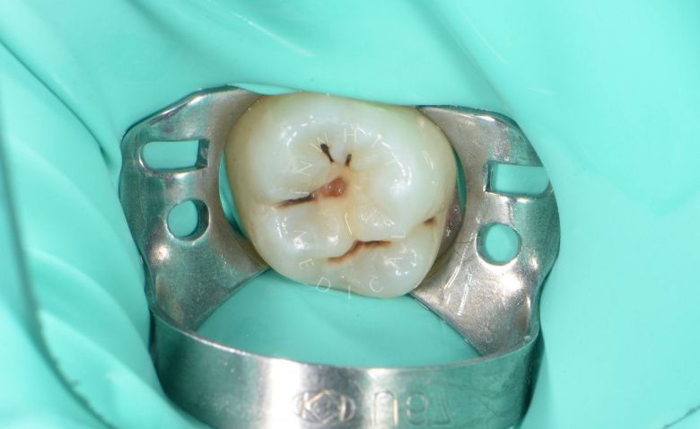 Детская стоматология Раменки. Лечение кариеса зуба у подростков - фото до процедуры