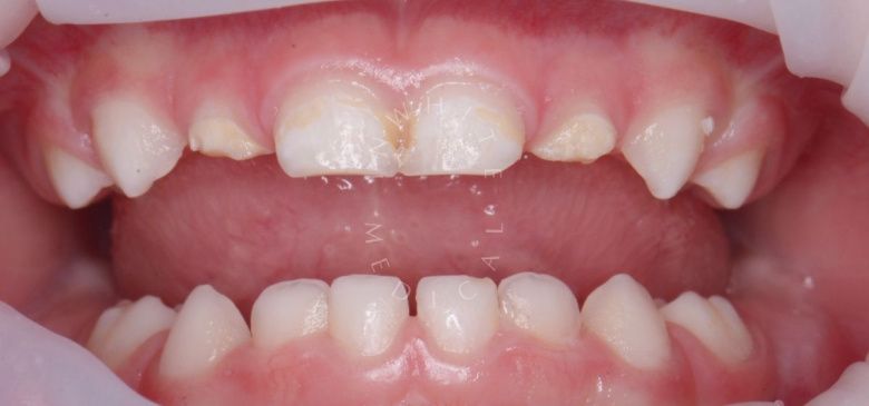 Лучшие стоматология для детей. Лечение под наркозом - профессиональная гигиена и установка 4 керамических коронок - фото до процедуры