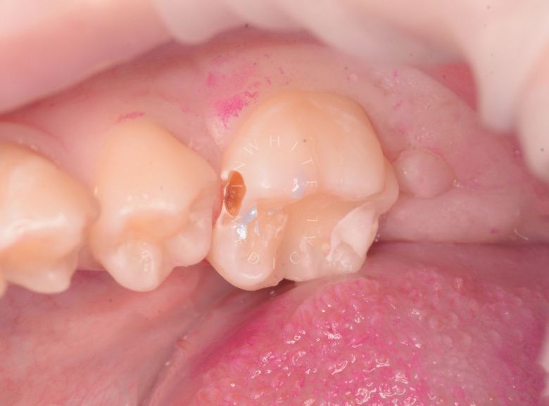  - фото до процедуры