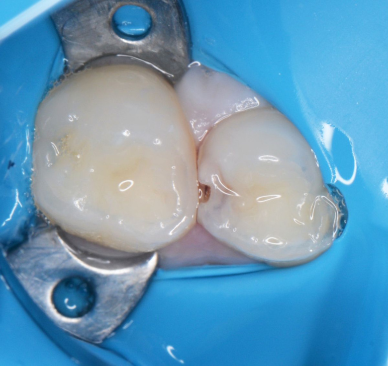  - photo before the procedure