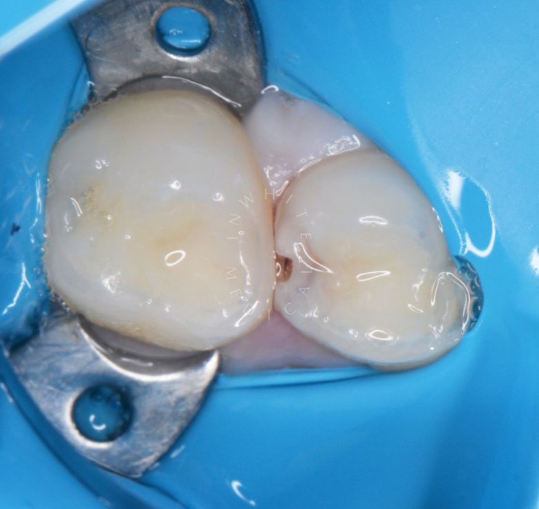 Лучшие стоматология для детей. Лечение контактного кариеса детям - фото до процедуры