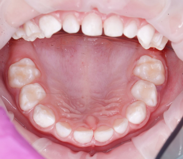  - photo after the procedure