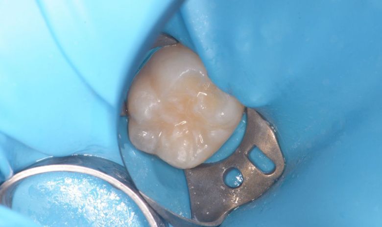  - photo after the procedure