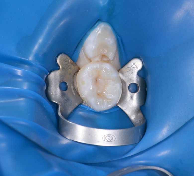 Самые лучшие детские стоматологи. Лечение кариеса и герметизация фиссур - фото до процедуры