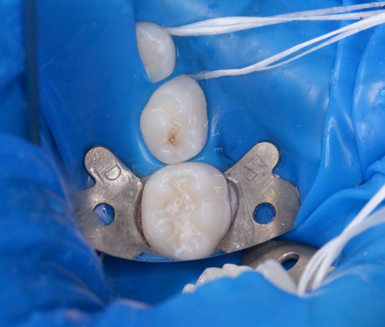 Самые лучшие детские стоматологи. Лечение кариеса детям - фото до процедуры