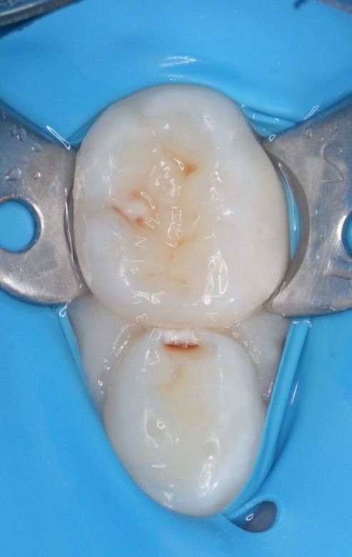 Лучшие стоматология для детей. Лечение кариеса с герметизацией фиссур детям - фото до процедуры