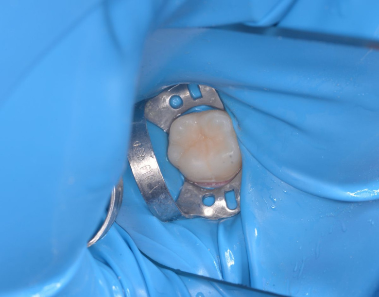  - photo after the procedure
