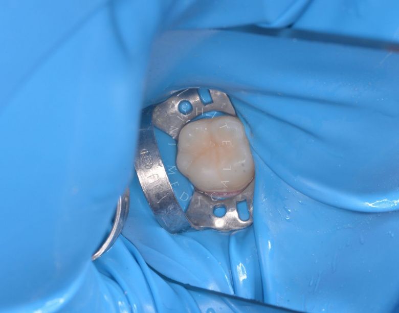 Лучшие стоматологии детские платные. Лечение кариеса постоянного зуба у детей - фото после процедуры