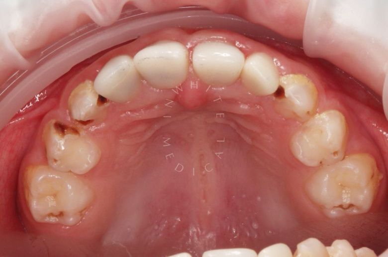 Детская стоматология лечение во сне. Лечение зубов с установкой керамических и железных коронок у детей - фото до процедуры