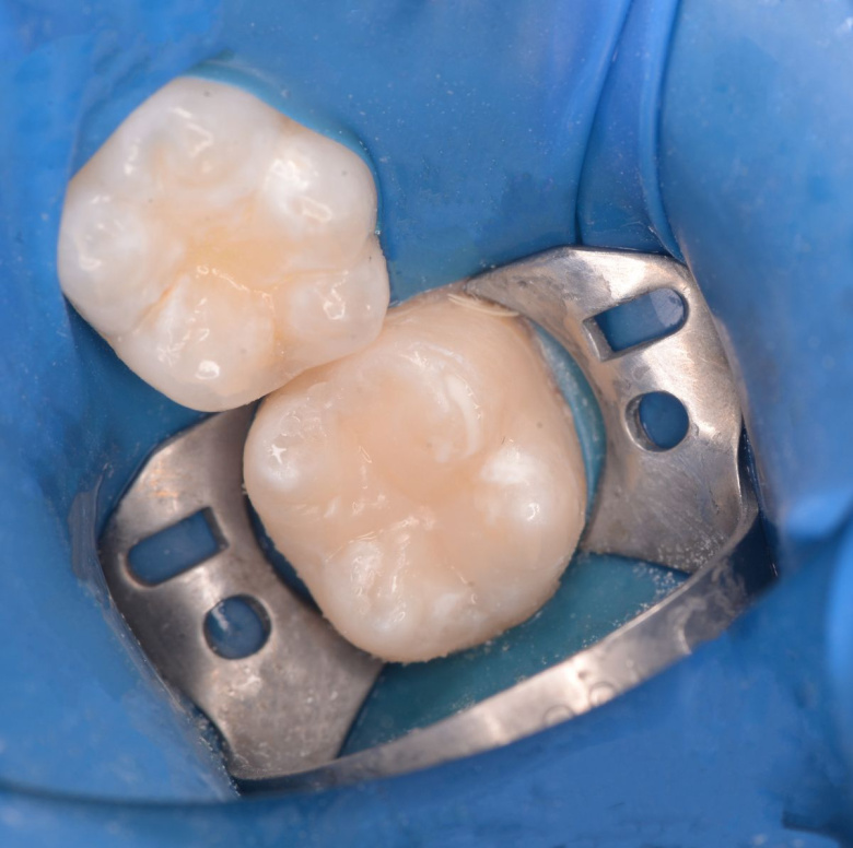  - photo after the procedure
