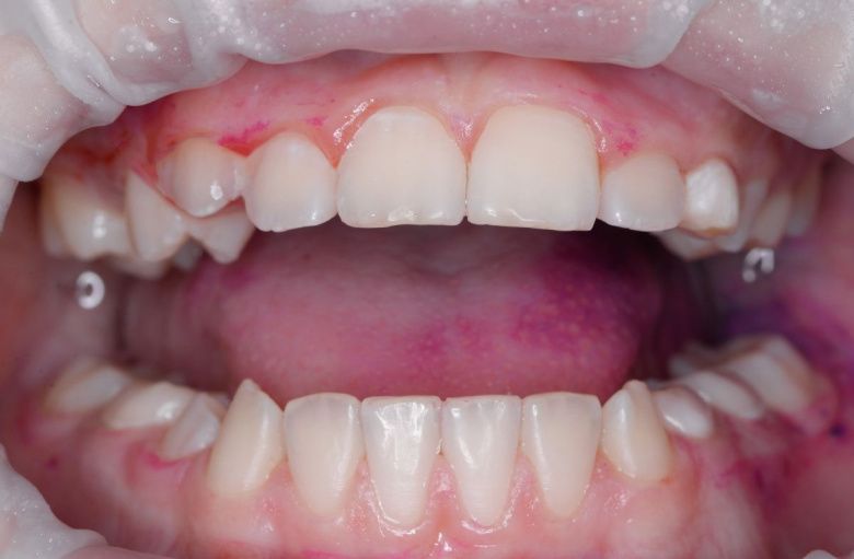  - photo after the procedure