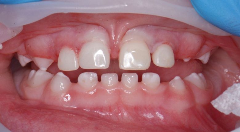  - photo after the procedure