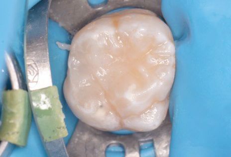  - photo after the procedure