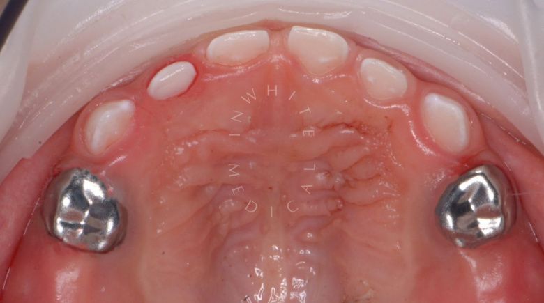 Лучшие стоматология для детей. Лечение детей в наркозе - установка металлических коронок - фото после процедуры