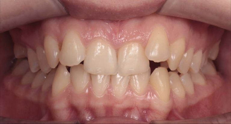  - photo before the procedure