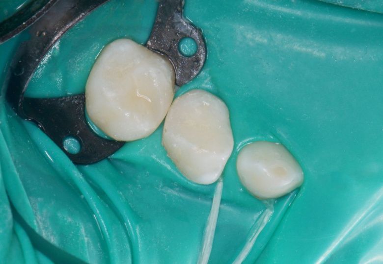  - photo after the procedure