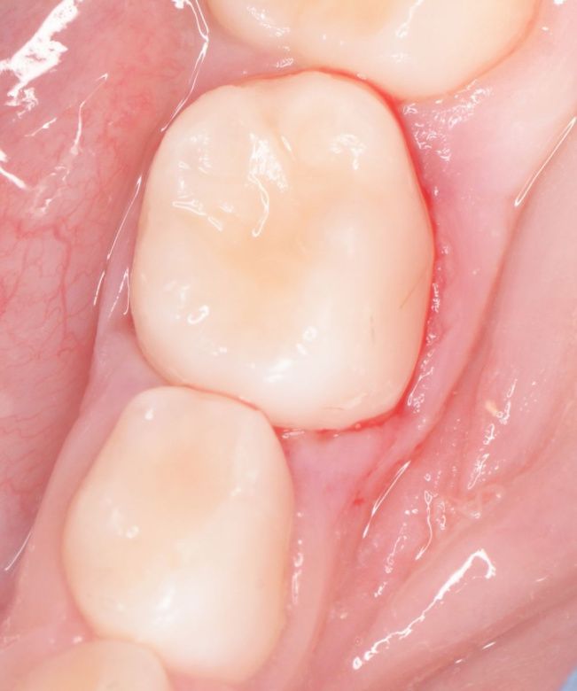  - photo after the procedure