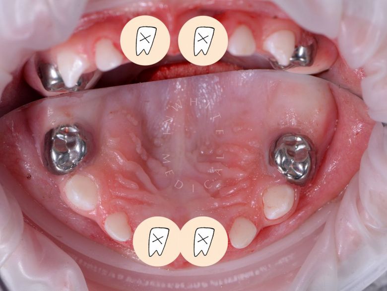 Самые лучшие детские стоматологи. Лечение зубов под наркозам у детей - фото после процедуры
