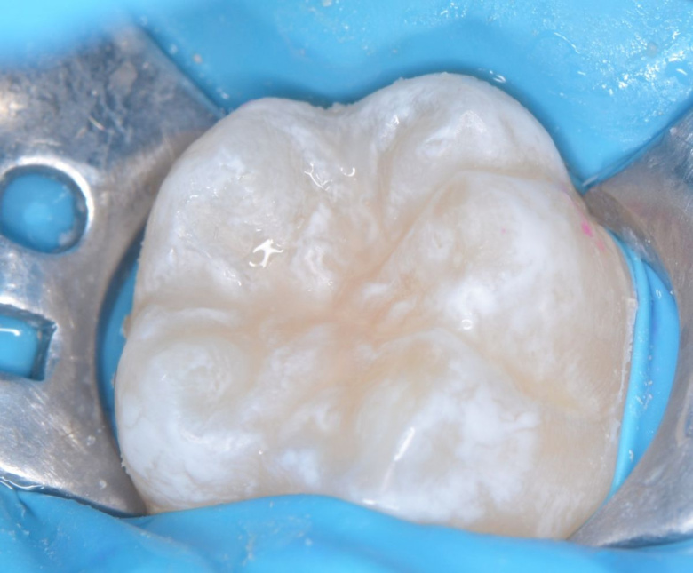 - photo after the procedure