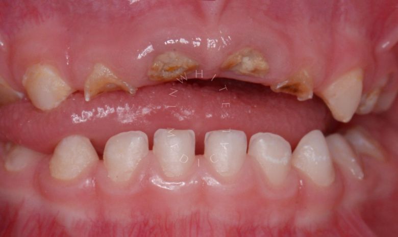 Лучшие стоматологии детские платные. Лечение во сне - установка керамических и металлических коронок - фото до процедуры